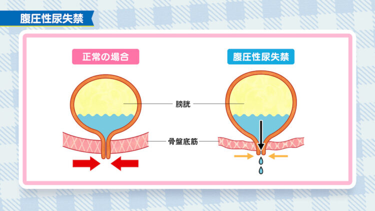 更年期　頻尿３