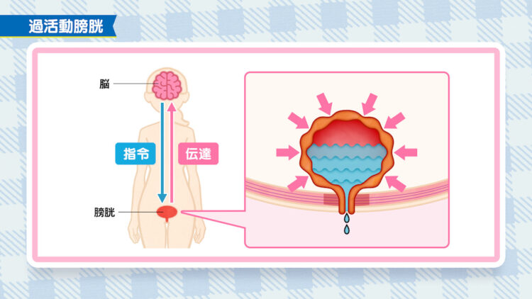 更年期　頻尿5